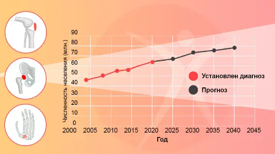 Зaболевaемость aртрозом и aртритом